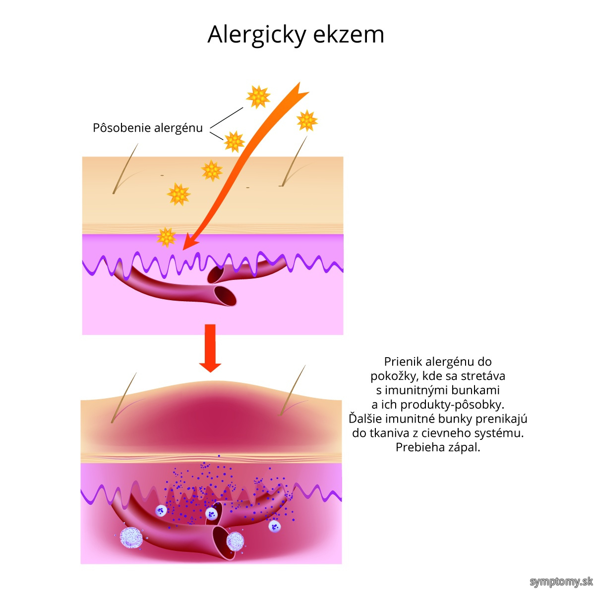 Alergicky ekzem