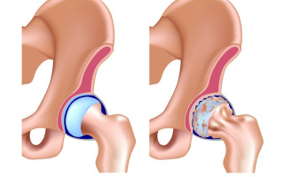 Artróza bedrového kĺbu