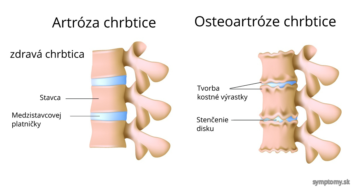 Artróza chrbtice