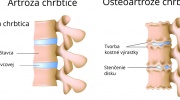 Artróza chrbtice