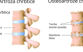 Artróza chrbtice