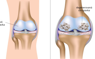 Artróza kolenného kĺbu