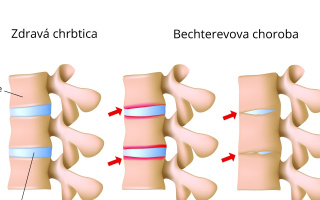 Bechterevova choroba