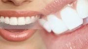 Bieliace pásiky na domáce bielenie zubov