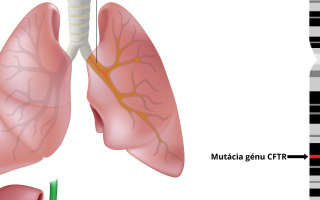 Cystická fibróza