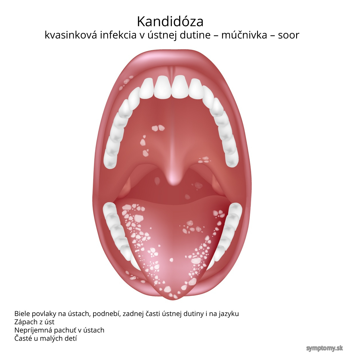 Kvasinková-infekcia-v-dutine-ústnej