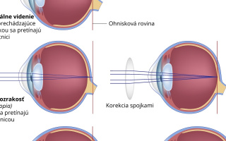 Krátkozrakosť