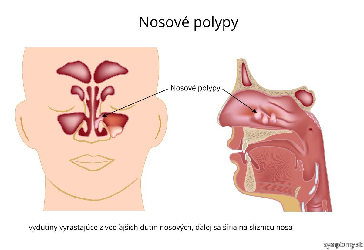 Nosové-polypy