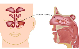 Nosové polypy