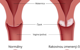 Rakovina krčka maternice