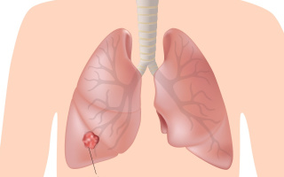 Rakovina pľúc