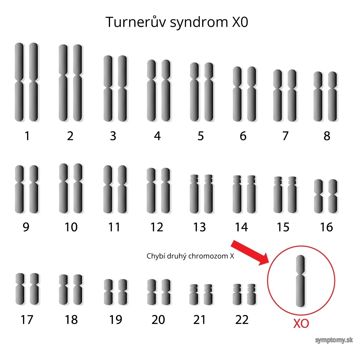 Turneruv-syndrom-x0