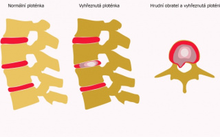 Vyskočenie medzistavcovej platničky