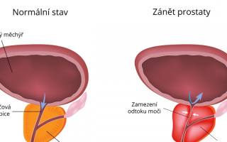 Zanet prostaty