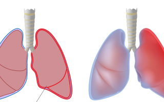 Zápal pohrudnice