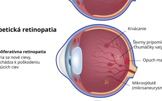 Diabetická retinopatia