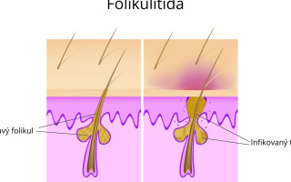 Folikulitída