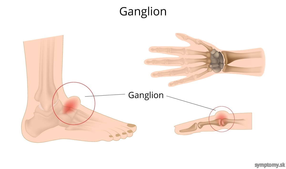 Ganglion na ruky a nohe