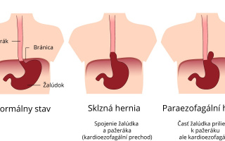 Hiátová hernia