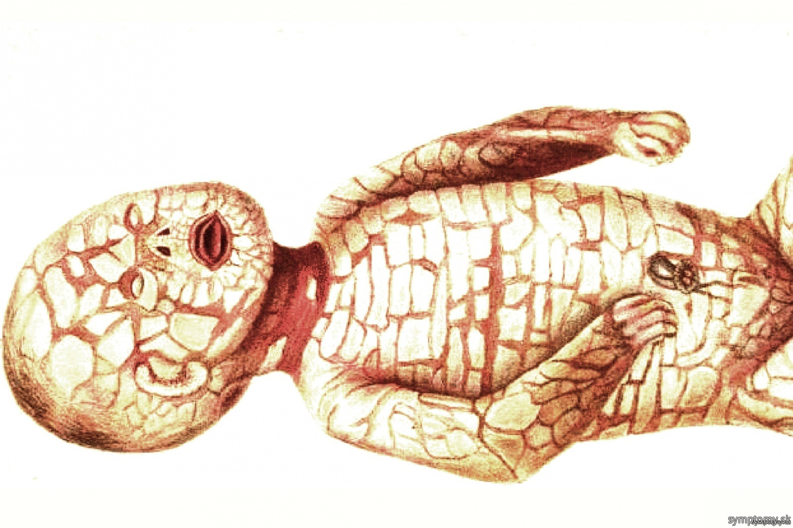 Harlequin ichthyosis