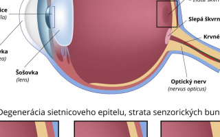 Makulárna degenerácia