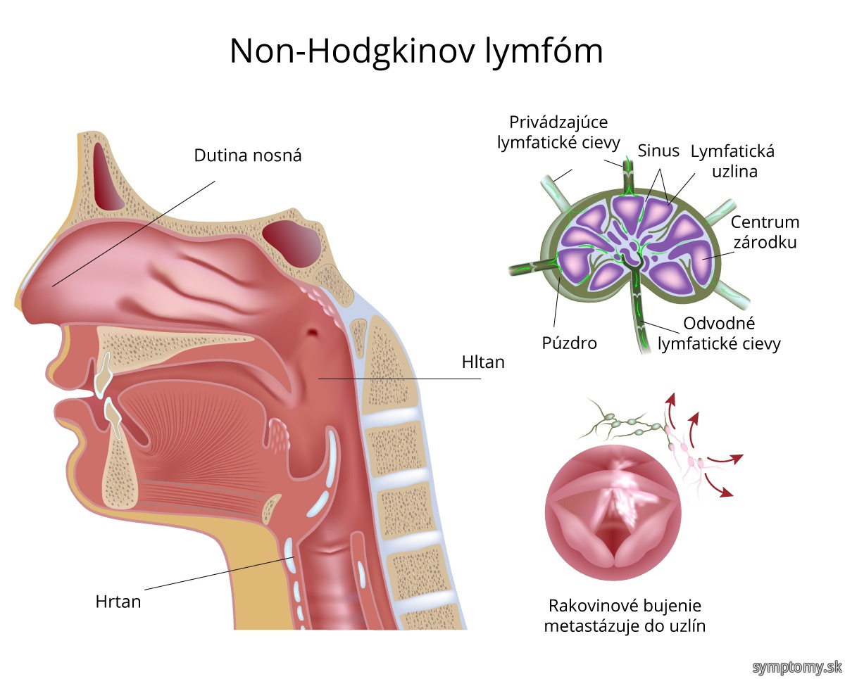 Non-Hodkinův lymfom