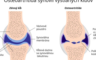 Osteoartritída