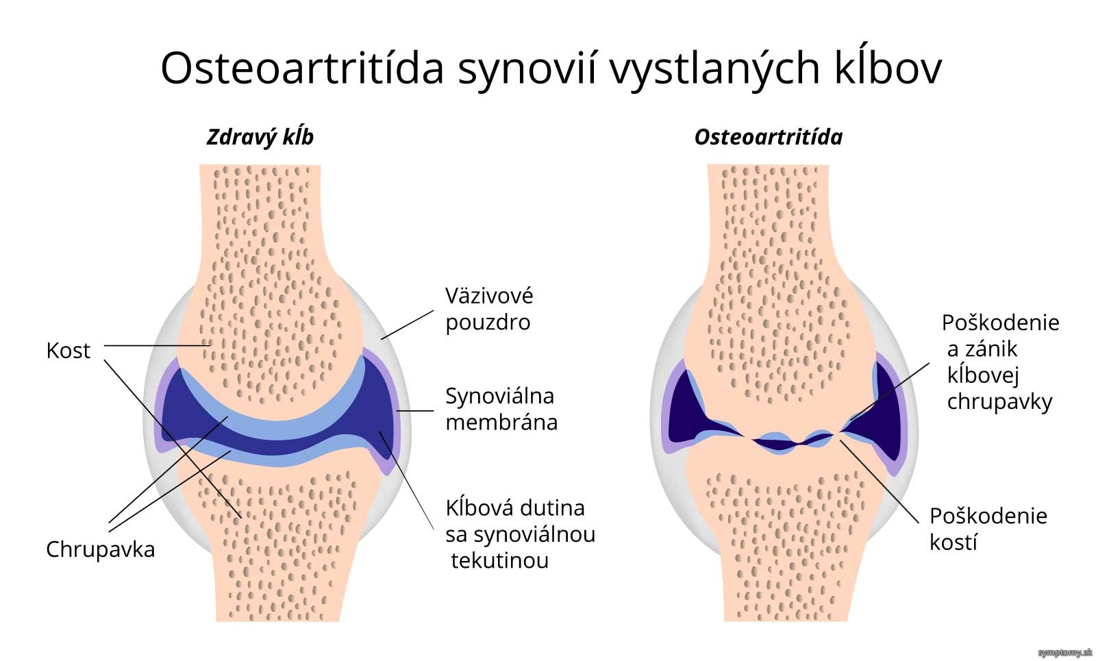 Osteoartrit da Pr znaky A Lie ba