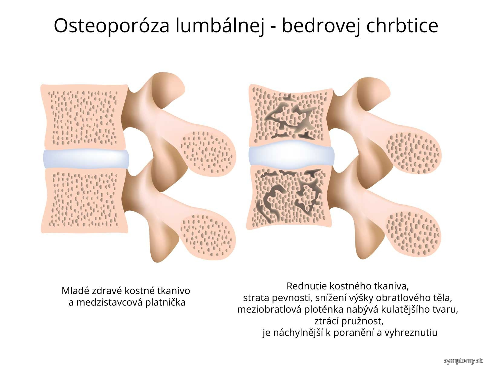Osteoporóza lumbálnej-bedrovej chrbtice.jpg