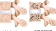 Osteoporóza bedrovej chrbtice