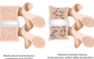 Osteoporóza bedrovej chrbtice