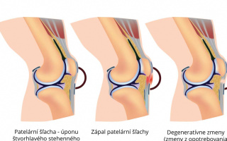 Patelárna tendinitída