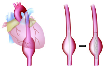 Aneuryzma hrudnej aorty 