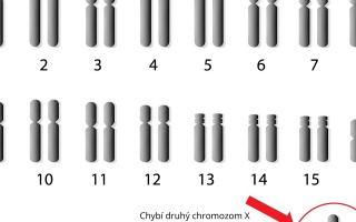 Turnerov syndróm