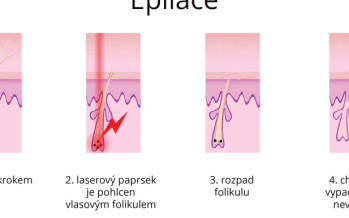 Laserová epilácia