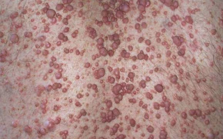 Neurofibromatóza