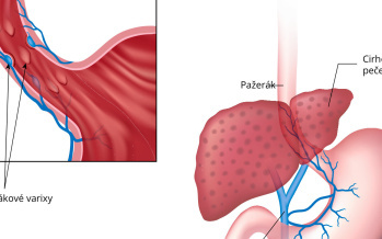 Pažerákové varixy