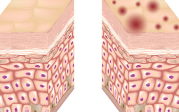Pemphigus