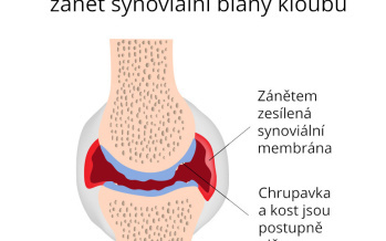 Synovitída