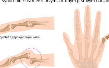 Vymknutie kĺbu prsta ruky 