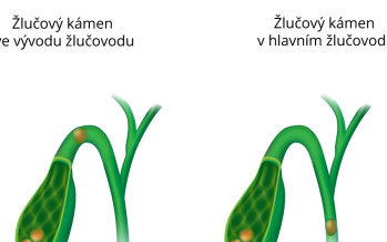 Žlčníkový záchvat