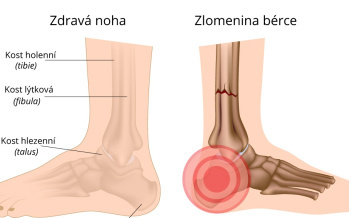 Zlomenina predkolenia vrátane členku