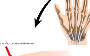 Zlomený článok prsta na ruke