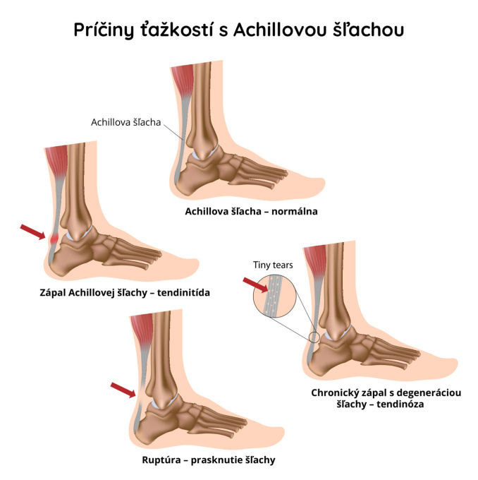 Achillova šľacha 