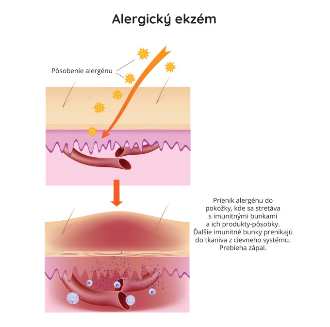 Alergicky ekzem