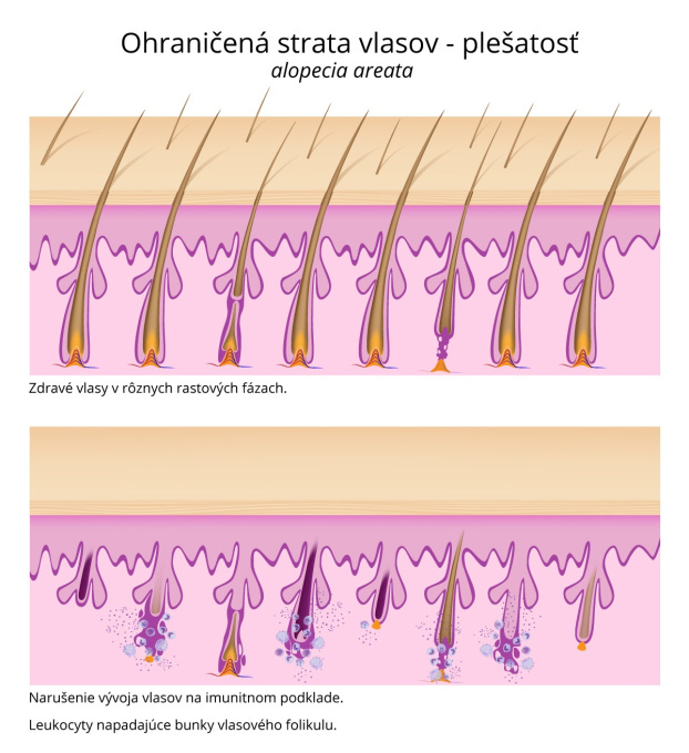 Ohraničená strata vlasov plešatosť alopecia areata