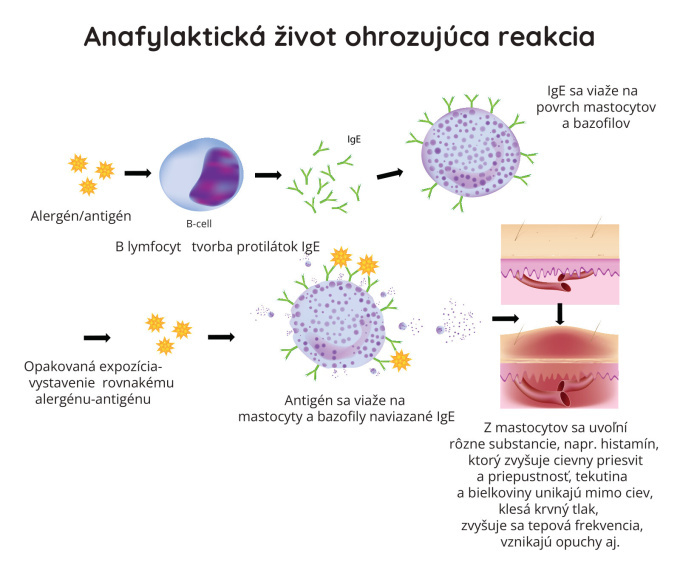 Anafylaktická život ohrozujúce reakcie