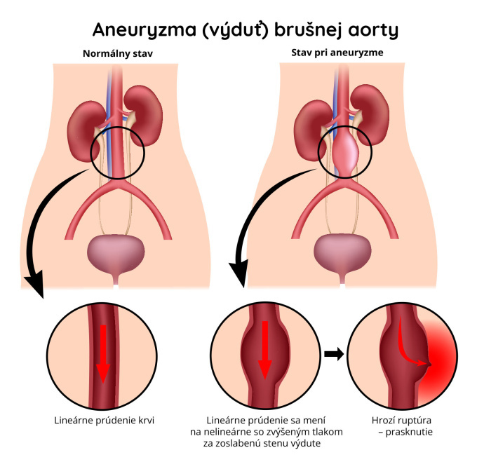 Aneuryzma brušnej aorty