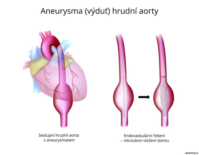 Aneuryzma hrudnej aorty 