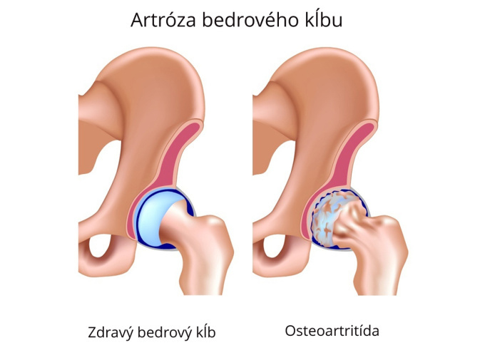 Artróza bedrového kĺbu